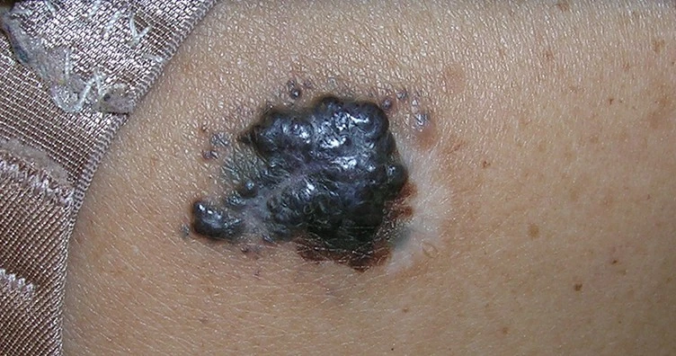 Vacuna que retrasa la aparición del cáncer de piel más mortífero.2